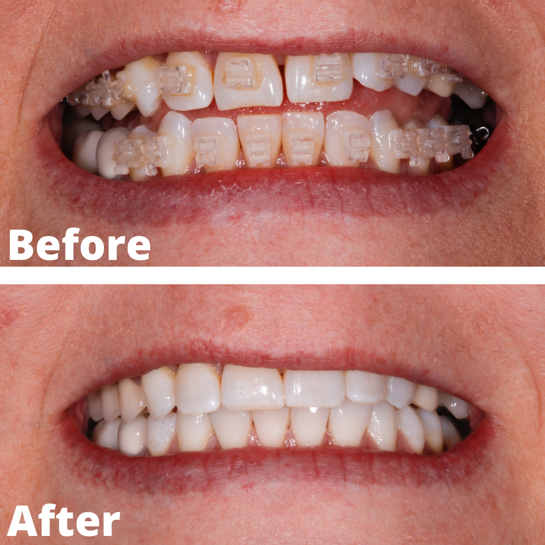 clear braces before and after