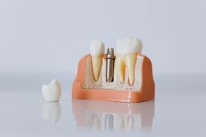 Photo by cottonbro studio: https://www.pexels.com/photo/close-up-shot-of-dental-implant-model-6502305/